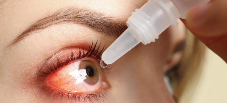 Dry Eye Disease: Symptoms, Causes, Diagnosis, Treatment & Prevention