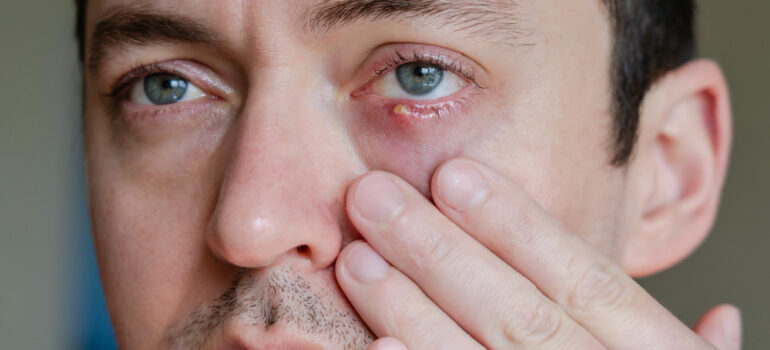 Chalazion: Causes, Symptoms, Diagnosis, and Effective Treatment